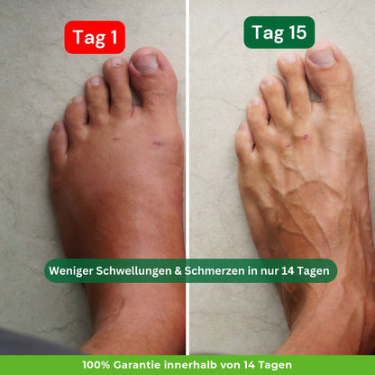 Kompressionsstrümpfe für mehr Lebensqualität