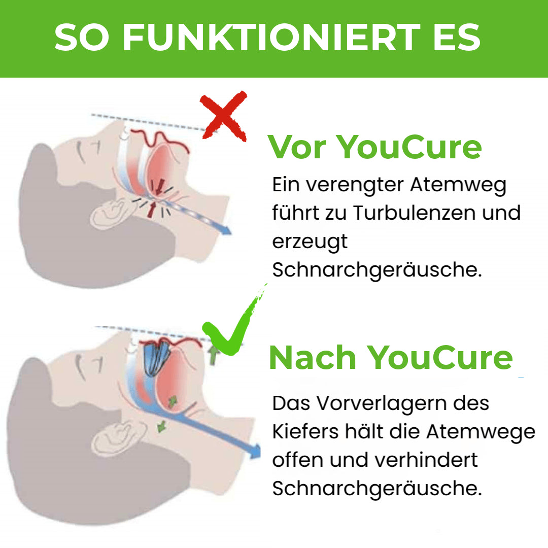 YouCure™ Anti-Schnarch-Mundstück