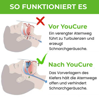 YouCure™ Anti-Schnarch-Mundstück